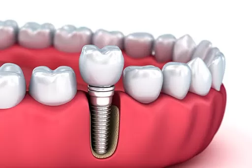 Implant - Tổng hợp tất cả các thông tin về Implant nha khoa implant