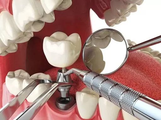 Implant - Tổng hợp tất cả các thông tin về Implant nha khoa implant