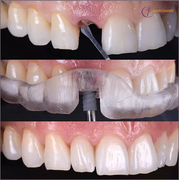 Implant - Tổng hợp tất cả các thông tin về Implant nha khoa Hoàn toàn có thể nhổ và cấy răng Implant tức thì trong một lần hẹn
