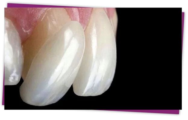 Veneer sứ là gì? Veneer