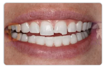 Veneer sứ cho nụ cười hoàn hảo veneer sứ