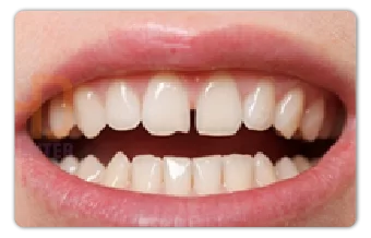 Veneer sứ cho nụ cười hoàn hảo veneer sứ