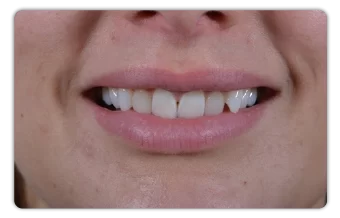 Veneer sứ cho nụ cười hoàn hảo veneer sứ