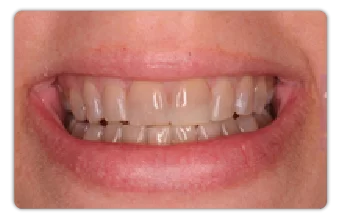 Veneer sứ cho nụ cười hoàn hảo veneer sứ