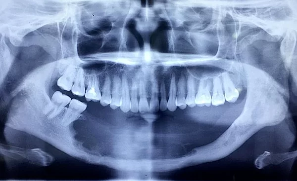 Implant - Tổng hợp tất cả các thông tin về Implant nha khoa implant