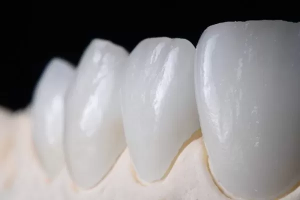 Veneer sứ là gì? Veneer la gì