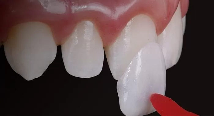 Veneer sứ là gì? Veneer su là gi
