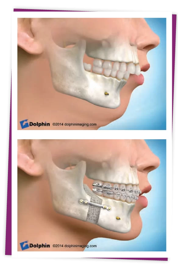 PHẪU THUẬT CHỈNH HÔ phẫu thuật hàm hô