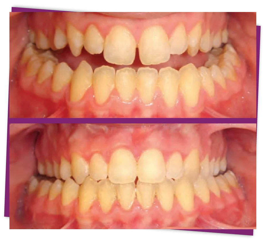 Phẫu thuật chỉnh móm - Chỉnh 1 lần đẹp trọn đời | Worldwide phẩu thuật chỉnh móm