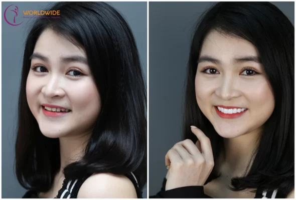 Được và mất khi làm răng sứ thẩm mỹ Nụ cười rạng rỡ với răng sứ ngọc trai của bạn TTH - khách hàng tại Worldwide.