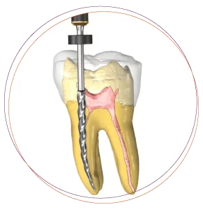 Root Canal Treatment (endodontics) Root canal treatment