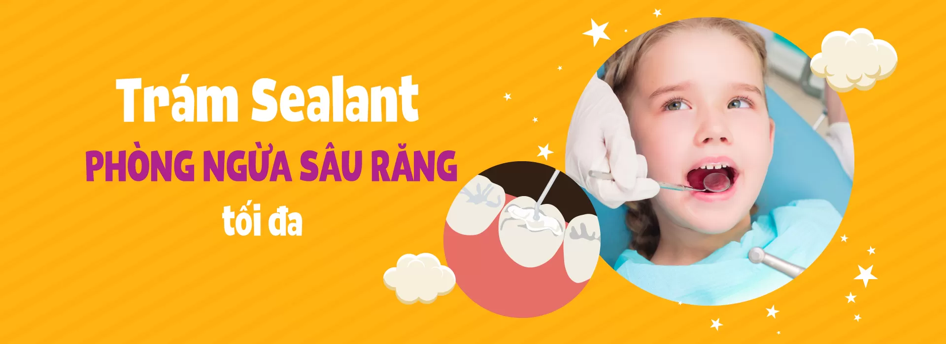 TRÁM SEALANT PHÒNG NGỪA SÂU RĂNG trám Sealant