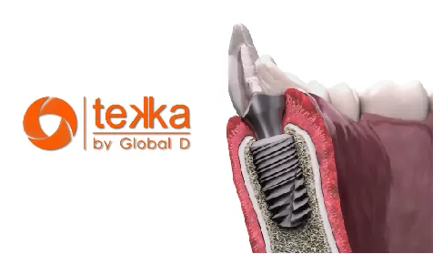 Những thương hiệu Implant có chất lượng tốt, giá “mềm” tại Kubet Worldwide TEKKA (Pháp)