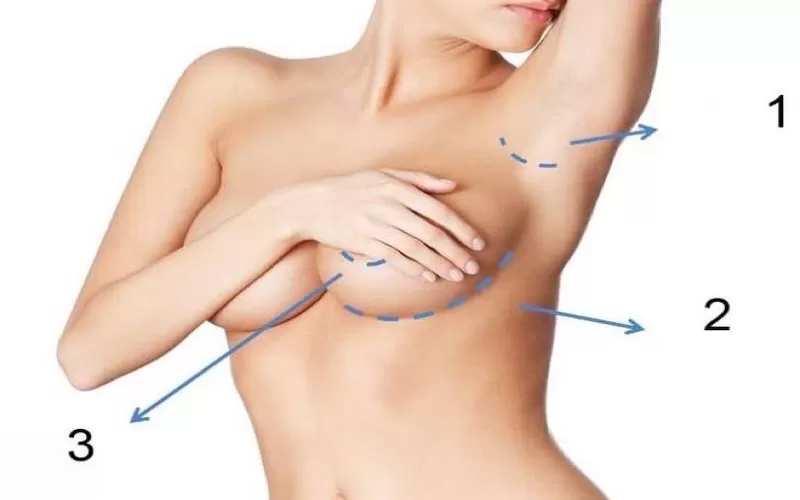 Phẫu thuật ngực nội soi là gì? Địa chỉ uy tín phẫu thuật ngực nội soi an toàn?
