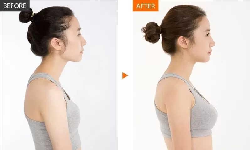 Các phương pháp nâng ngực tự nhiên Nâng ngực bằng mỡ từ thân