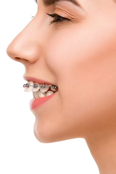Overbite Surgery ADVANTAGES OF OVERBITE SURGERY