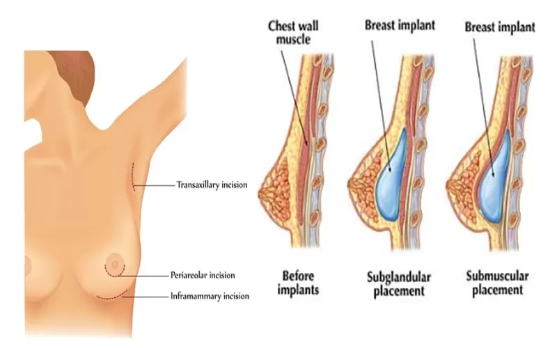 Phẫu thuật ngực nội soi là gì? Phẫu thuật ngực nội soi là gì?