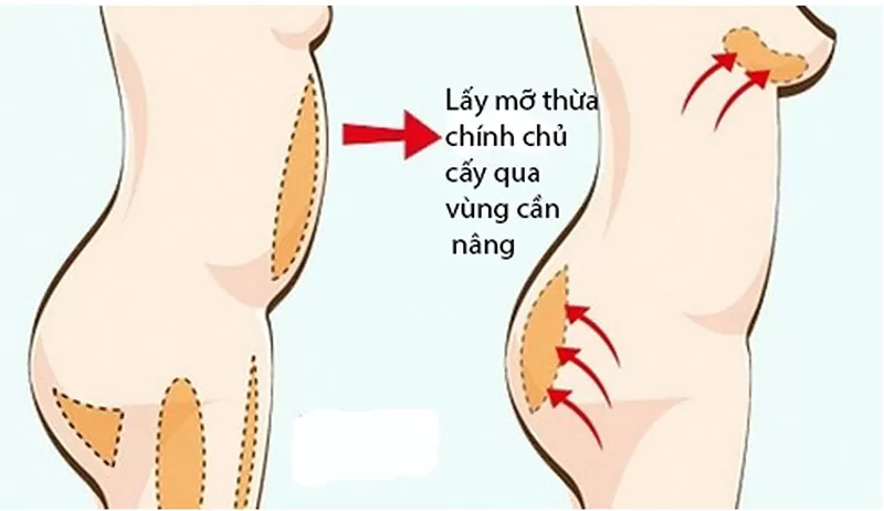 Nâng ngực bằng mỡ tự thân tại bệnh viện Worldwide Nâng ngực bằng mỡ tự thân