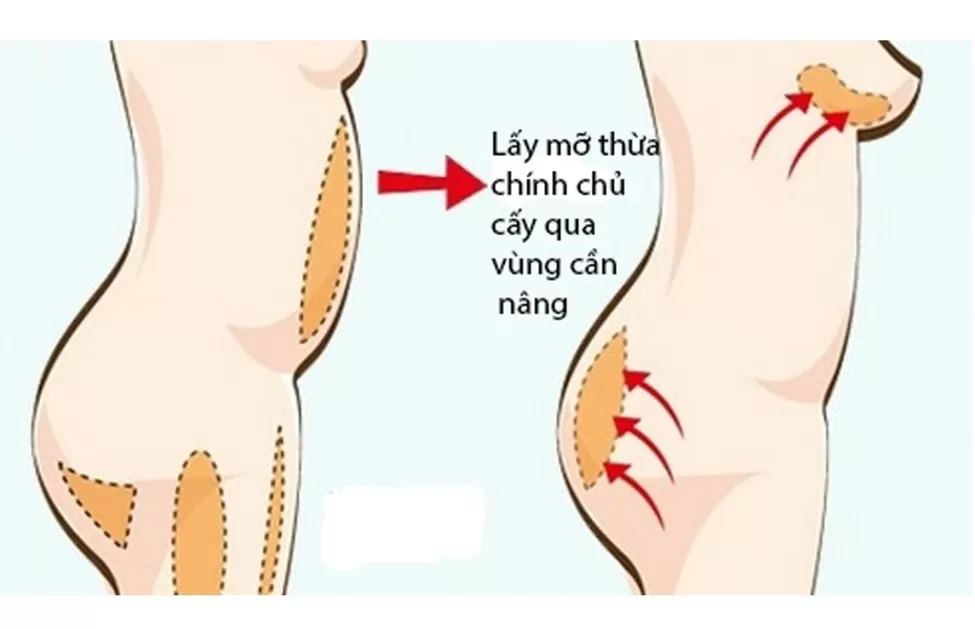 Nâng ngực không phẫu thuật ở đâu uy tín? Nâng ngực không phẫu thuật với phương pháp tiêm mỡ tự thân