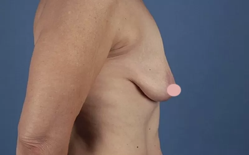 Nâng ngực nội soi có đau không? Bao lâu thì hồi phục? Ngực xệ, lép cần nâng ngực nội soi