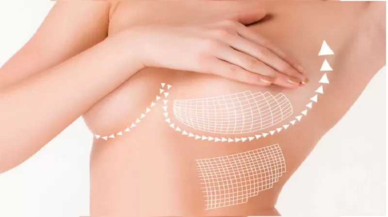 Những lưu ý khi phẫu thuật nâng ngực Phẫu thuật nâng ngực mỡ tự thân