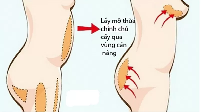 Nâng ngực có an toàn không? Liệu có tiền mất tật mang? Phương pháp nâng ngực bằng mỡ tự thân