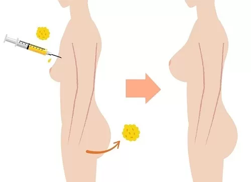 Bơm ngực bằng mỡ tự thân - Phương pháp bơm ngực không cần phẫu thuật Quy trình bơm ngực bằng mỡ tự thân
