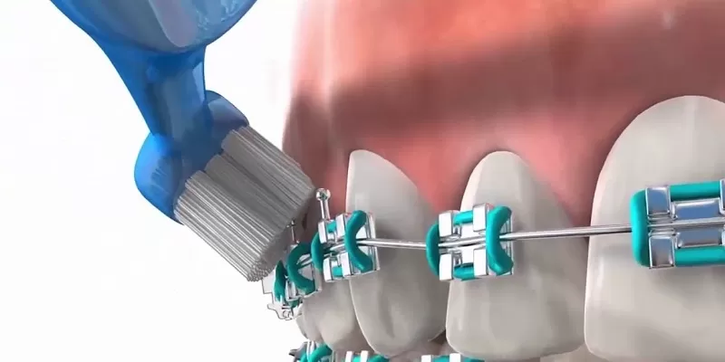 Chăm sóc sau khi răng niềng Bàn chải răng niềng
