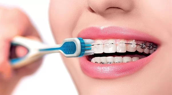 Chăm sóc sau khi răng niềng Chải răng niềng