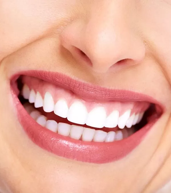 Điều trị cười hở nướu tại Kubet WORLDWIDE Điều trị cười hở nướu