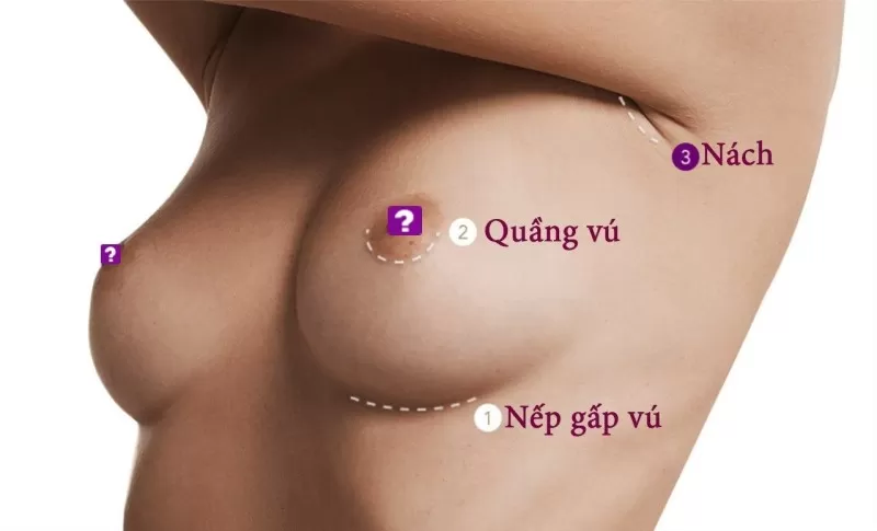Phẫu thuật nâng ngực có đau không? Các đường nâng ngực nhẹ nhàng