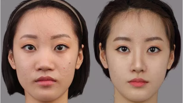 Phẫu thuật thu nhỏ đầu mũi không bị to lại, đẹp như sao Hàn? Có nên phẫu thuật thu nhỏ đầu mũi hay không
