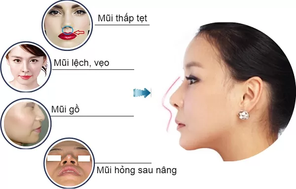 Có nên nâng mũi sụn tự thân hay không? Làm đẹp từ xương sụn trên cơ thể
