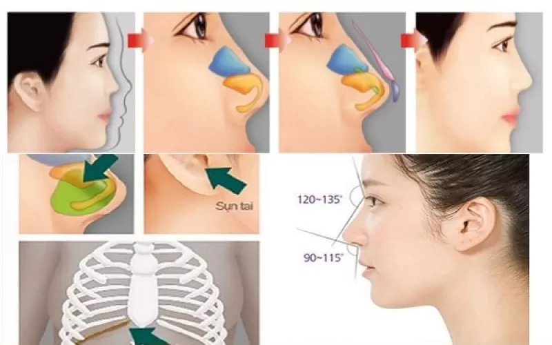 Ưu Điểm Và Nhược Điểm Của Nâng Mũi Bằng Sụn Tự Thân Nâng mũi bằng sụn tự thân