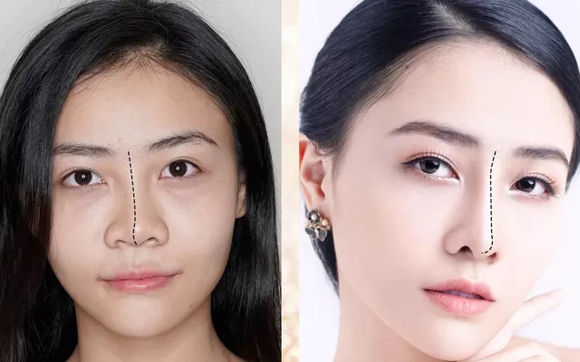 Có nên nâng mũi sụn tự thân hay không? Nâng mũi sụn tự thân an toàn tự nhiên