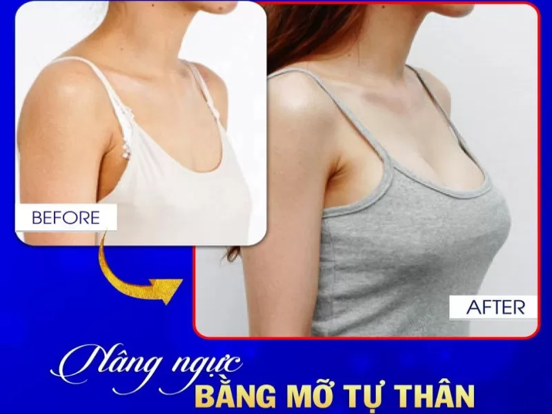 Nâng Ngực Bằng Mỡ Tự Thân Giá Bao Nhiêu? Ưu Đãi Trả Góp? Nâng ngực bằng mỡ tự thân giá bao nhiêu?