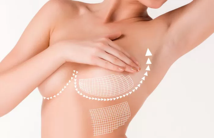 Nâng ngực không phẫu thuật là như thế nào? Nên nâng ngực không phẫu thuật ở đâu?