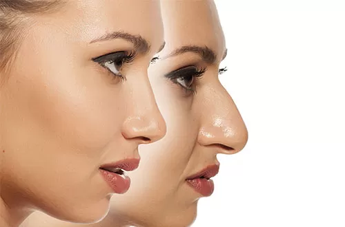 Phẫu thuật thu nhỏ đầu mũi không bị to lại, đẹp như sao Hàn? Nên phẫu thuật thu nhỏ đầu mũi ở đâu là tốt nhất