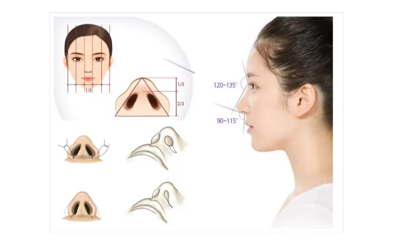Phẫu thuật thu gọn cánh mũi - Tăng vận may, hút tài lộc Phẫu thuật thu gọn cánh mũi là gì?