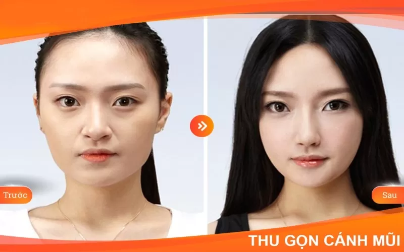 Thu gọn cánh mũi mất bao lâu? Có để lại sẹo không? Phẫu thuật thu gọn cánh mũi