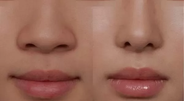 Phẫu thuật thu nhỏ đầu mũi không bị to lại, đẹp như sao Hàn? Phẫu thuật thu nhỏ đầu mũi là gì