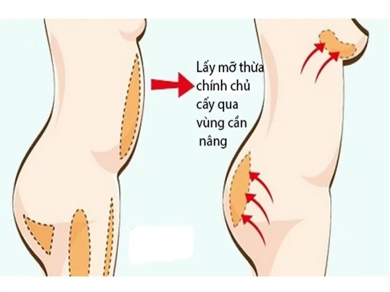 Nâng ngực tự nhiên bằng mỡ tự thân Phương pháp nâng ngực tự nhiên là gì?