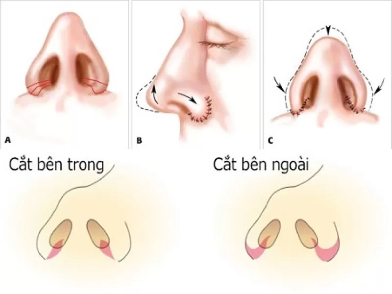 Có Thể Thu Nhỏ Đầu Mũi Và Cánh Mũi Cùng Một Lúc không? thu nhỏ đầu mũi và cánh mũi