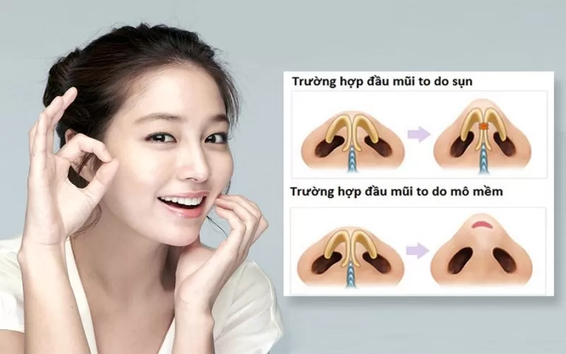 Những dịch vụ thẩm mỹ nâng mũi hiện nay Thu nhỏ đầu mũi
