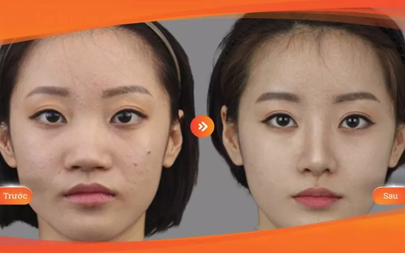 Có Thể Thu Nhỏ Đầu Mũi Và Cánh Mũi Cùng Một Lúc không? Thu nhỏ đầu mũi và cánh mũi cùng một lúc