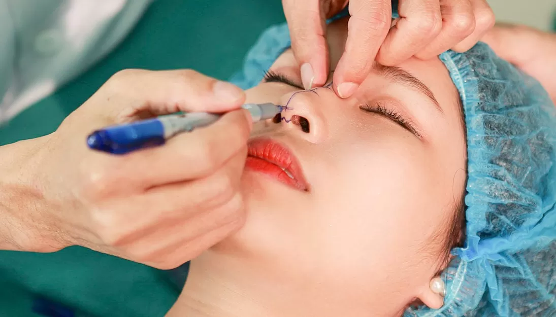 Nâng mũi bọc sụn có vĩnh viễn không? Nâng mũi bọc sụn có vĩnh viễn không?