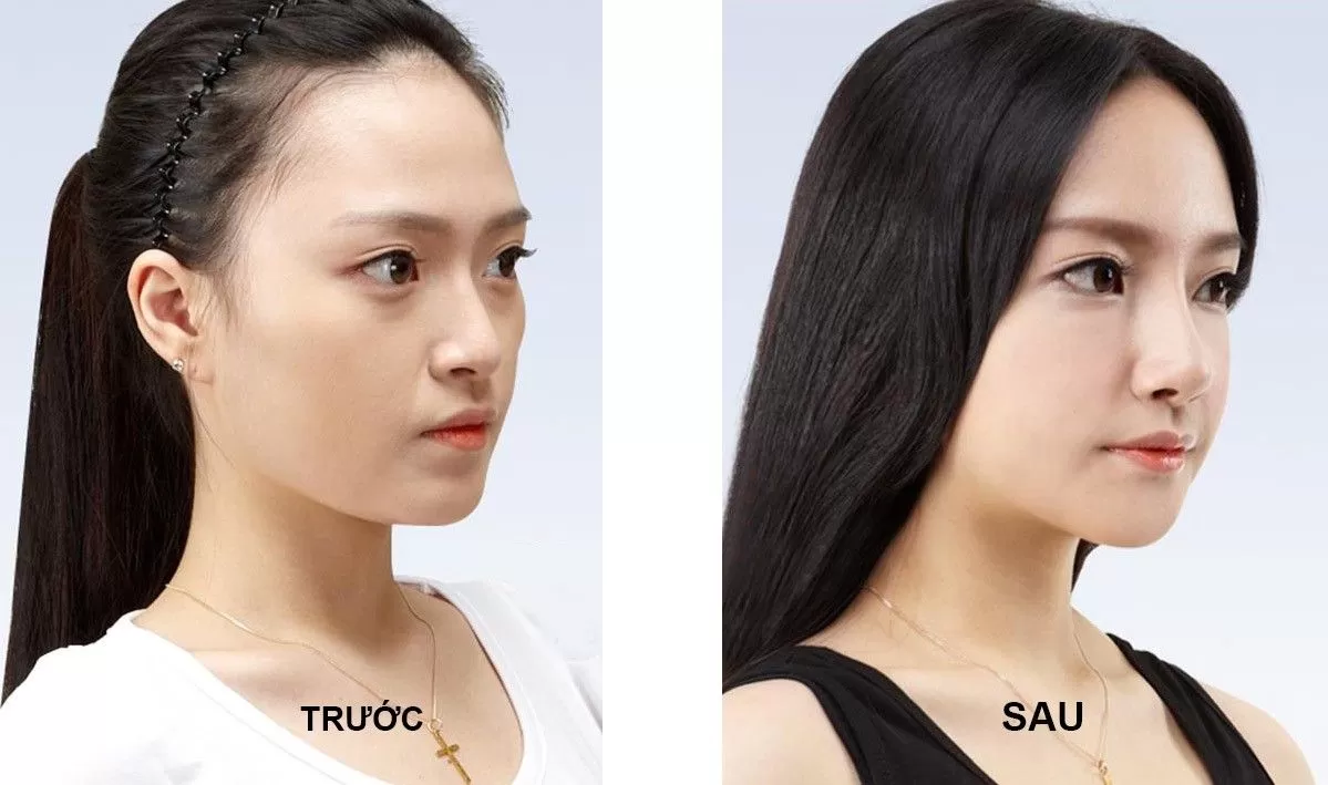 Nâng mũi bọc sụn có vĩnh viễn không? Nâng mũi bọc sụn là gì?