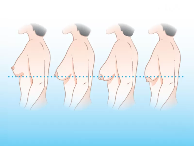 Nâng ngực chảy xệ giá bao nhiêu? Nâng ngực chảy xệ giá bao nhiêu sẽ phụ thuộc phần lớn vào mức độ chảy xệ của ngực