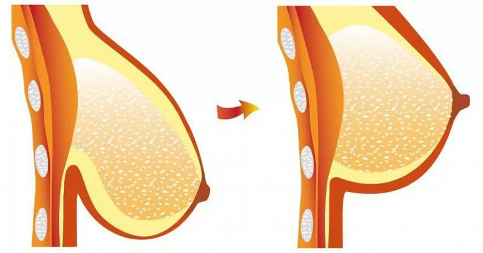 Nâng ngực chảy xệ giá bao nhiêu? Nâng ngực chảy xệ giá bao nhiêu?