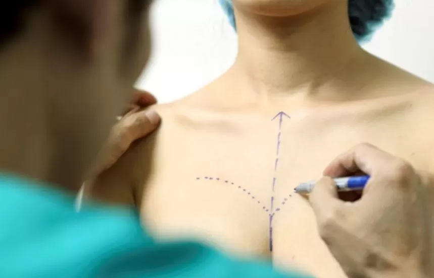 Nâng ngực được bao nhiêu năm? Chất liệu túi độn ảnh hưởng đến nâng ngực được bao nhiêu năm